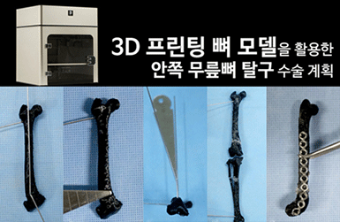 3D 프린팅 뼈 모델을 활용한 안쪽 무릎뼈 탈구 수술 계획