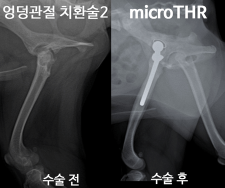 엉덩관절 치환술2 수술 전, micro THR 수술 후