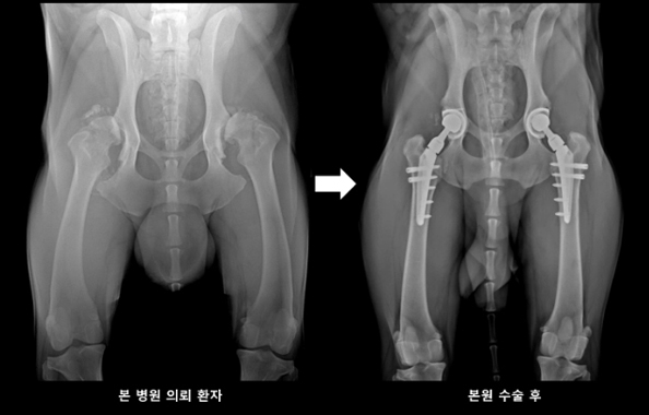 인공 관절 치환술 수술 전 및 수술 후 사진