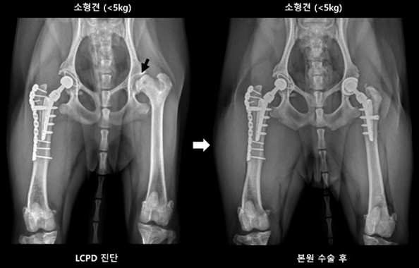 마이크로 인공 관절 치환술 수술 전 및 수술 후 사진