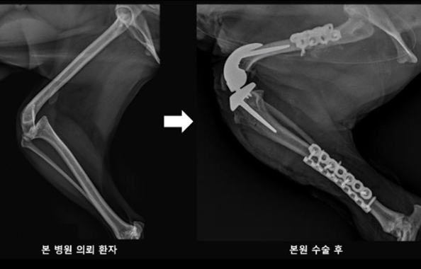 인공 무릎 관절 전치활술 수술 전 및 수술 후 사진