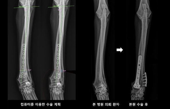 뼈기형 교정 후 사진