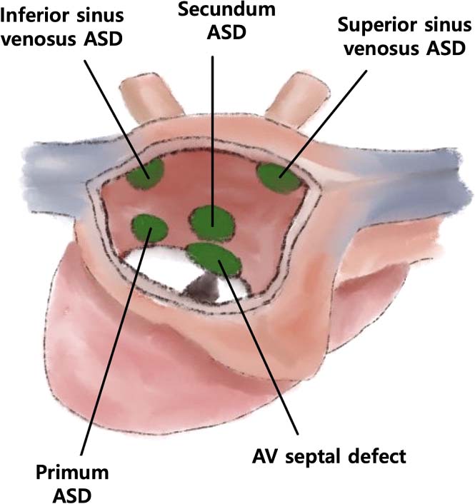 심방중격결손 분류 그림
