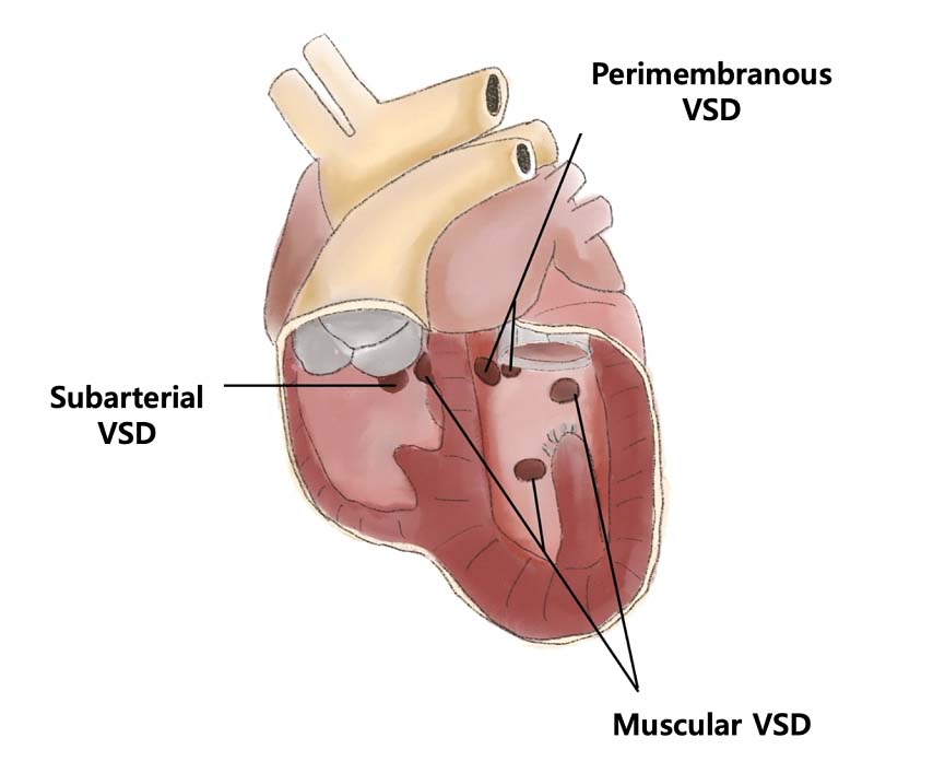 심실중격결손 분류 그림