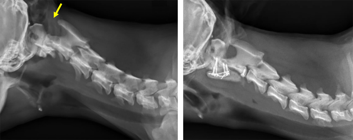 환축추 관절의 불안정한 상태(왼쪽), 수술후 사진(오른쪽)