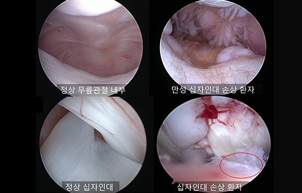 정상 무릎 관절과 십자인대 손상 환자의 무릎관절경 사진