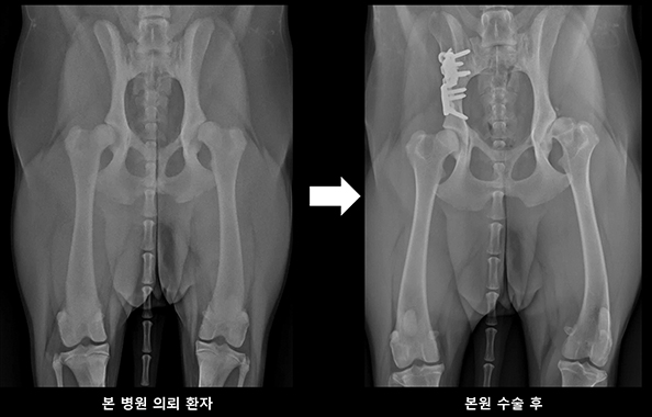 이중골반뼈자름술을 수술 전 및 수술 후 사진