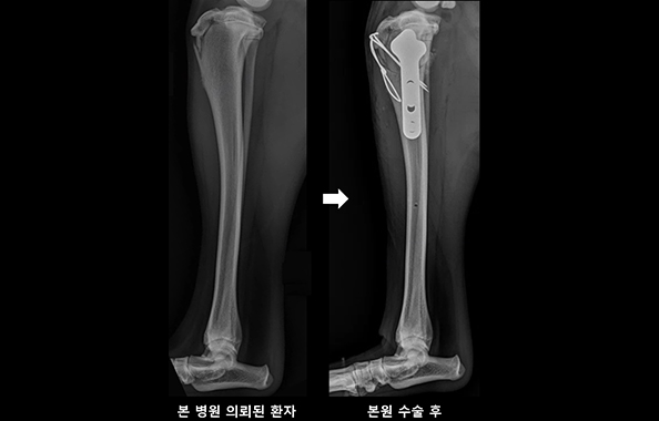 CBLO (CORA (center of rotation of angulation) 기반 수평 절골술) 수술 후 사진