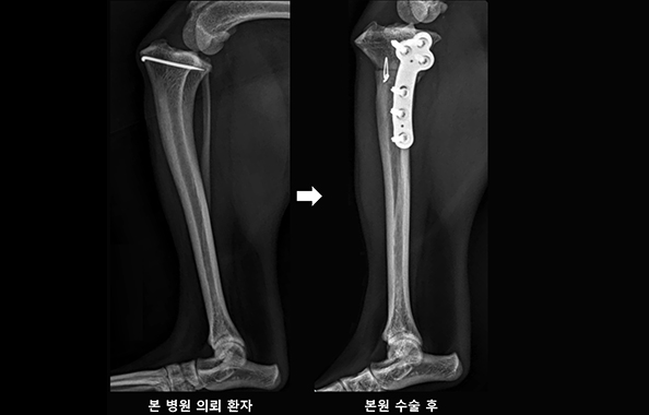 TWO(정강뼈 쐐기뼈 자름술) 수술 전 및 수술 후 사진