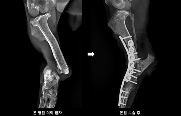 뒷말목 관절 고정술 후 사진