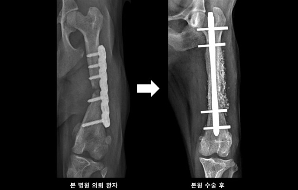 교합성 골수정과 동종골 이식을 이용한 불유합 골절 교정한 수술 사진
