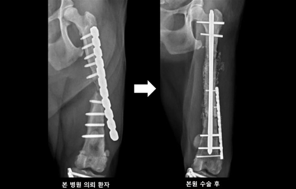 교합성 골수정과 동종골 이식을 이용한 불유합 골절 교정한 수술 사진