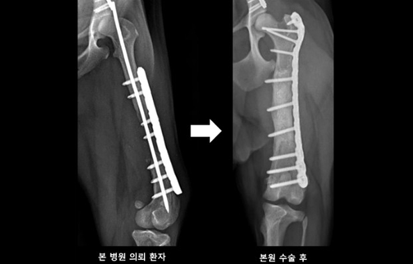 동종뼈이식을 이용하여 불유합 골절 교정한 수술 사진