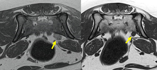 말초 신경 종양에 따른 방사선 치료 후 종양 크기 감소