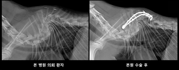 척추 기형 환자의 방사선 사진