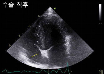 수술사진