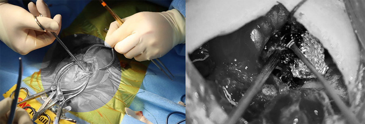 신경현미경을 이용한 뇌종양 수술, 신경현미경 수술 사진(오른쪽)