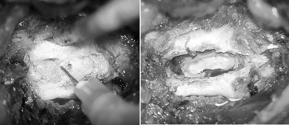 신경현미경을 이용한 수술; 척수 거미막 곁주머니 제거 수술 사진